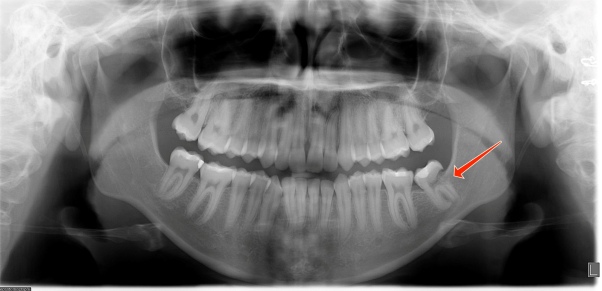 Damage Resulting from Impacted Wisdom Teeth